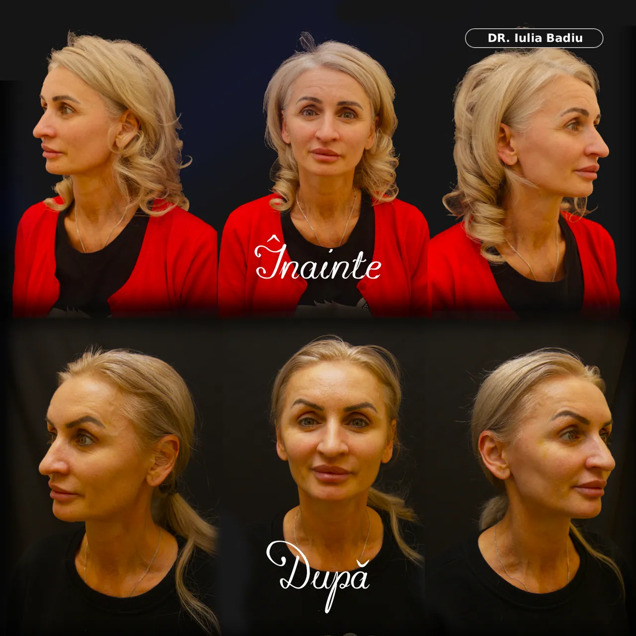 Colaj înainte și după tratament — Dr. Teo